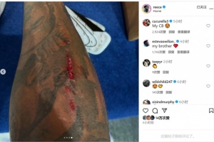 踢满全场+客串中卫！里斯-詹姆斯社媒晒腿上伤口